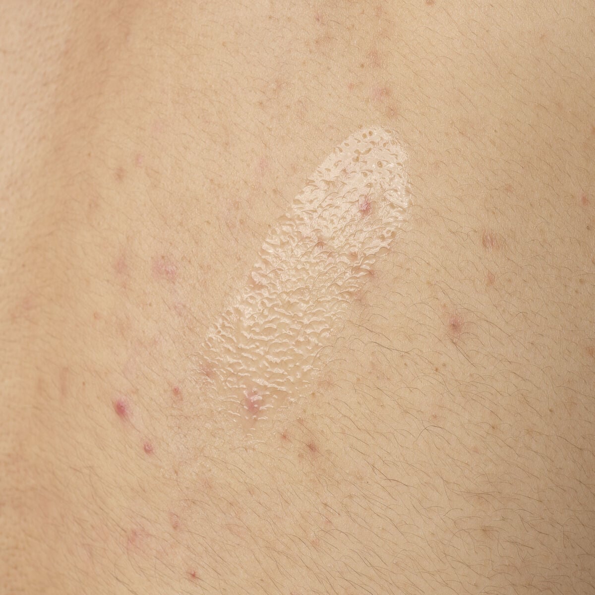 salicylic-acid-0-5-body-serum-y8 ORD-salicylic-acid-05-body-240ml-application.jpg