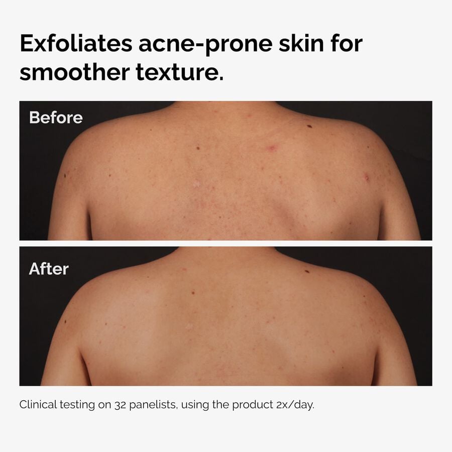 the-body-care-collection-q6 ord-salicylic-acid-body-serum-before-after-graphic-NA.jpg