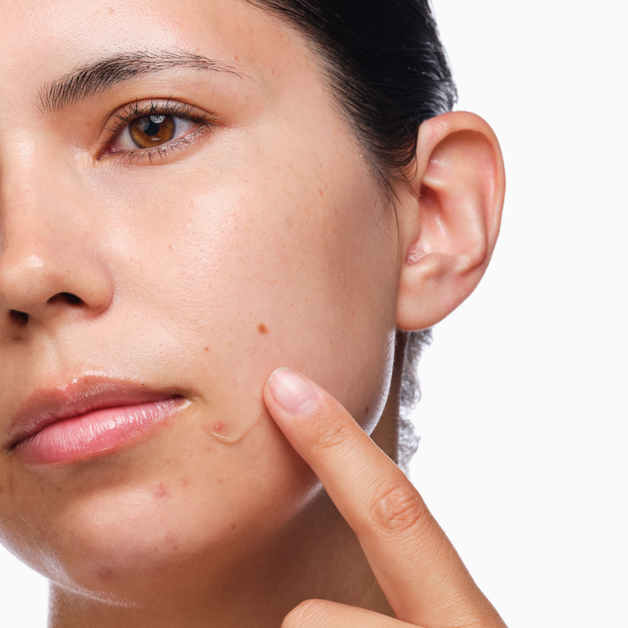 the-acne-set-a5 rdn-the-acne-set-application.png